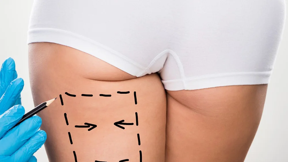 Thigh Lift